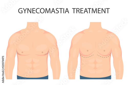 Vector illustration of gynecomastia in men. For advertising cosmetic plastic procedures