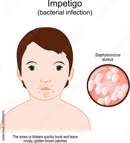 Impetigo. Face baby with a skin infection