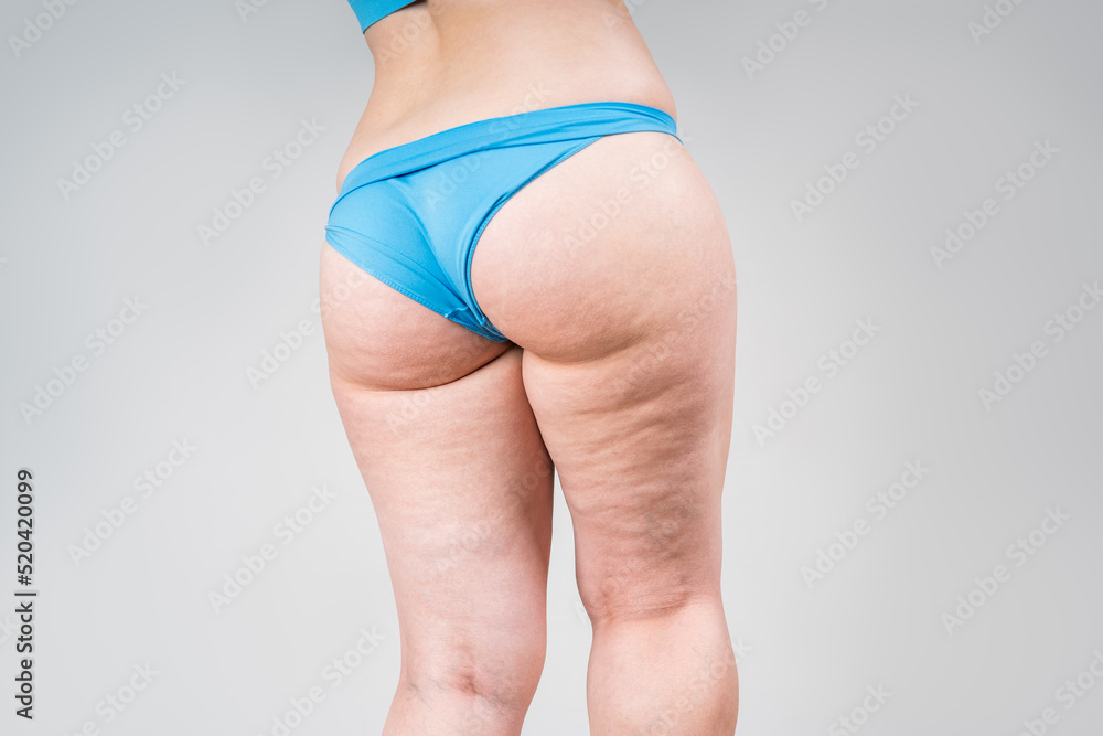 Overweight thigh, woman with fat hips and buttocks, obesity female body with cellulite on gray background - obrazy, fototapety, plakaty 