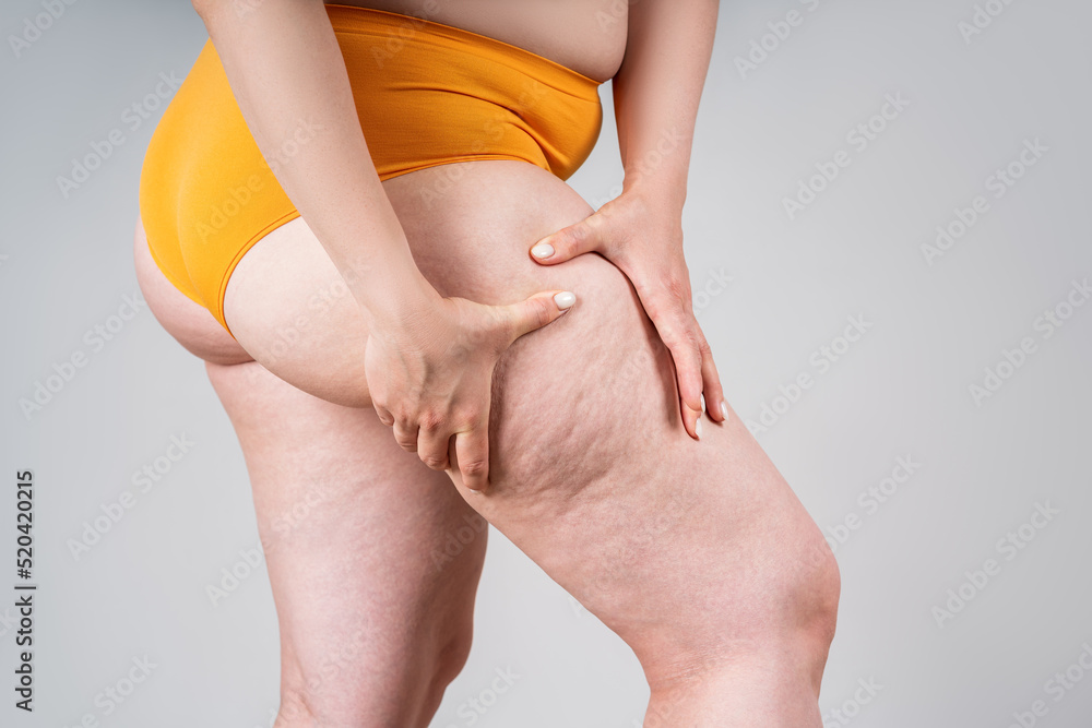Thigh and butt discount fat