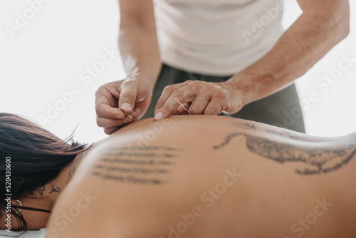 backlighting of therapist sticking acupuncture needles in a woman's back