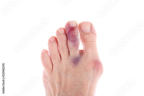 Bruised injured middle toe, big toe with bunion photo