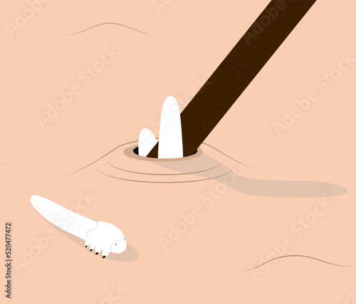 Demodex mites blocking hair follicles and laying on skin. Illustration of light skin infected with demodicosis. 