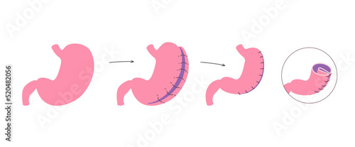 Gastric plication flat infographics. The explanation picture of stomach reduce method via laparoscopic operation photo