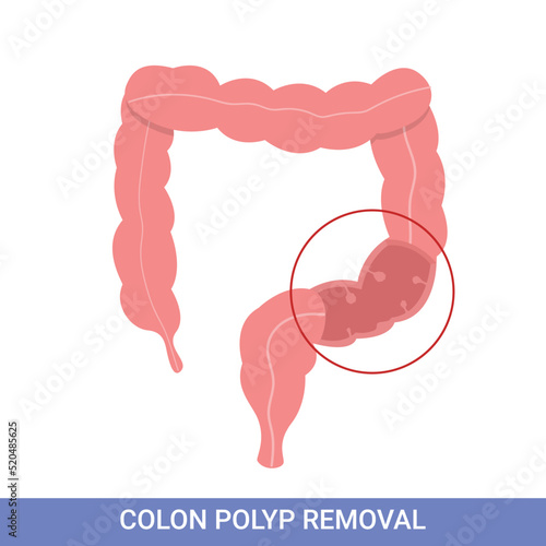 Colonoscopy intestine, polypectomy procedure, removal polyp in colon. colon surgery photo