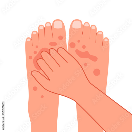 Hand scratching foot in flat design. Man or woman suffering from strong allergy skin itchy symptom concept. Red rash skin irritation.