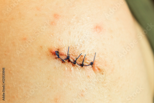 Medical sutures after operations, sewn surgical sutures on the human body
