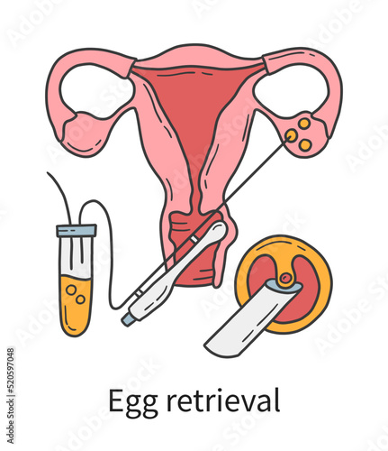 Egg retrieval and transvaginal oocyte extraction from ovaries, In Vitro fertilization IVF vector illustration in doodle hand drawn style