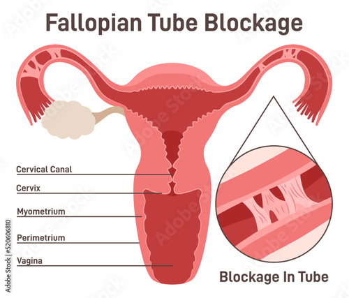 Fallopian tubes obstruction. Blocked fallopian tube preventing photo