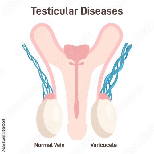 Varicocele. Testicular Disease, enlargement of the veins in the scrotum
