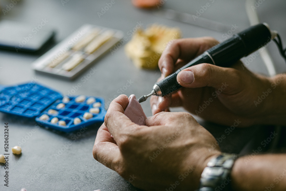 mechanical retention for adhesion of resin of dental prosthesis Stock