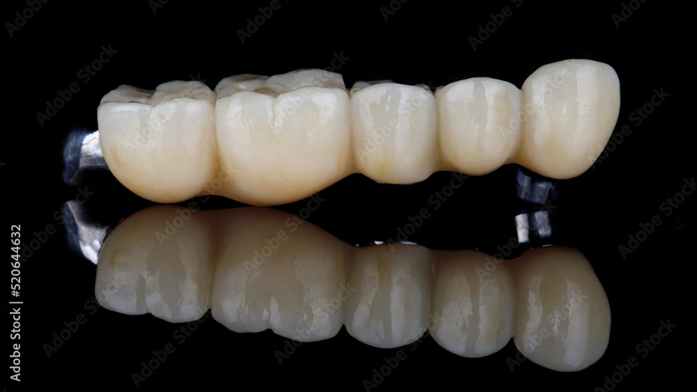 Ceramic bridge prosthesis for five teeth with a titanium beam on a black background with a reflection