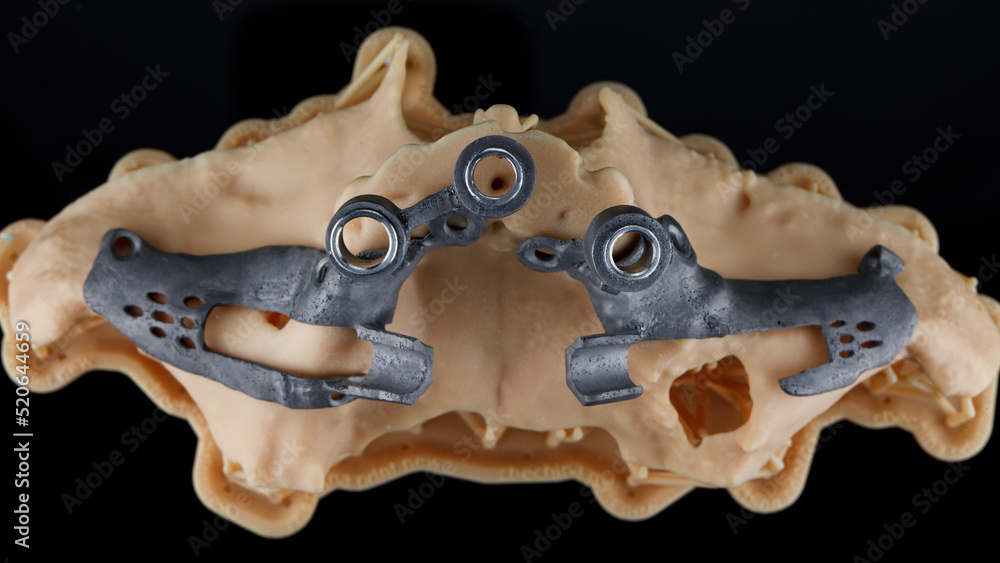 special dental model with templates for zygomatic implantation, top view on a black background