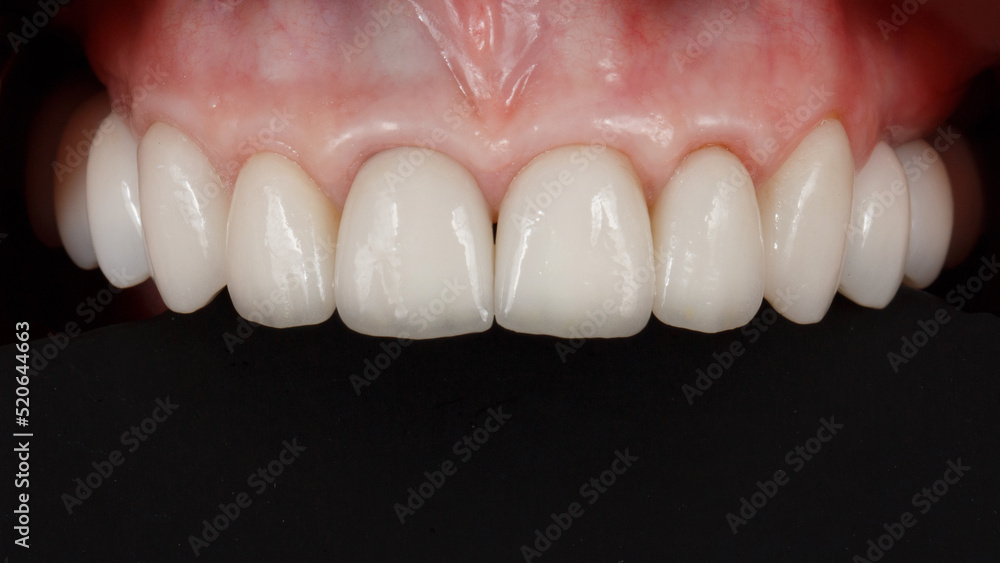 upper jaw with ceramic veneers and crowns on a black background upper jaw with ceramic veneers and crowns on a black background