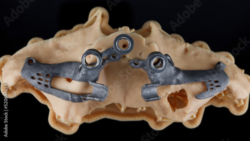 special dental model with templates for zygomatic implantation, top view on a black background photo
