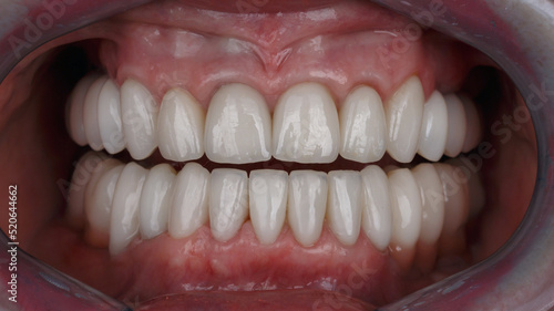 patient's oral cavity with ceramic veneers and bridges