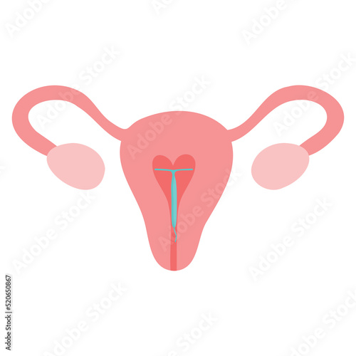 Hormonal IUD. Copper Intrauterine device colored flat style icon. Women contraceptive birth control methods. Female contraception.