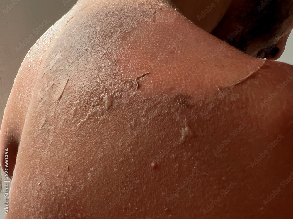 Fototapeta premium Peel back and shoulder skin from sunburn effect on young man body from sunbathing in summer