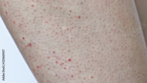 Close-up of the leg skin covered with red rash, pimples and irritation. Concept of scabies, allergy and cosmetology.