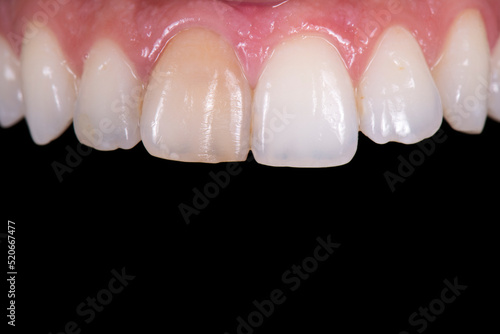 dameged discolored central incicor due to an accident