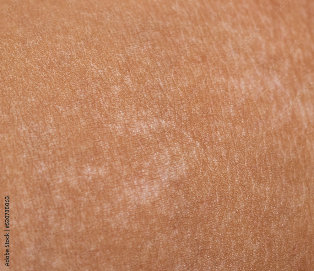 pigment spots on the skin after a sunburn Stock Photo Adobe Stock
