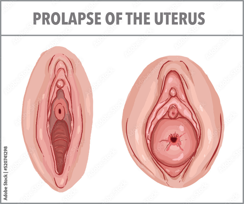 Prolapse of the uterus. gynecology vector illustration Stock Vector