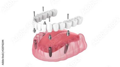 Dental prosthesis all-on-4 system supported by implants