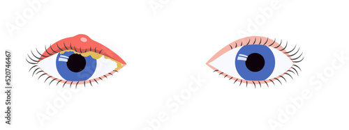 Blue eyes comparison of healthy state and blepharitis symptoms, swelling, mucus. Eye disease medical illustration.