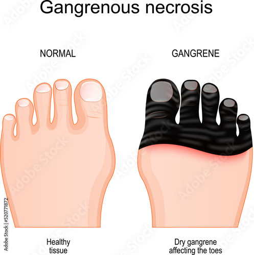 Gangrene affecting the toes.. tissue death by Gangrenous necrosis photo