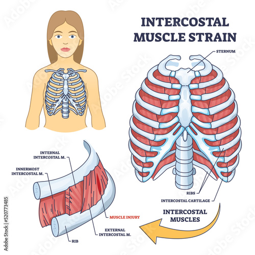 Intercostal muscle strain as muscular group in chest cavity outline diagram. Labeled educational medical scheme with skeleton and lungs muscle for ribcage respiratory movement vector illustration. photo