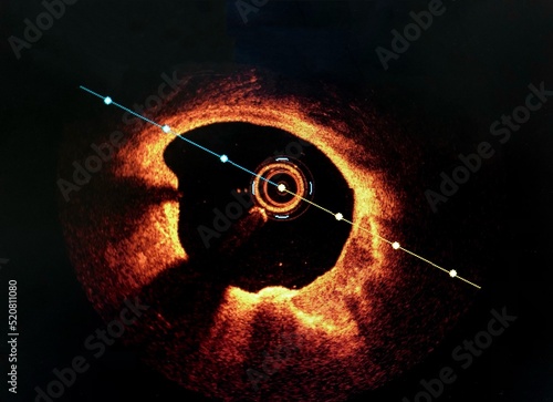Foto Intravascular imaging Optical Coherence Tomography (OCT) shown calcified coronary lesion