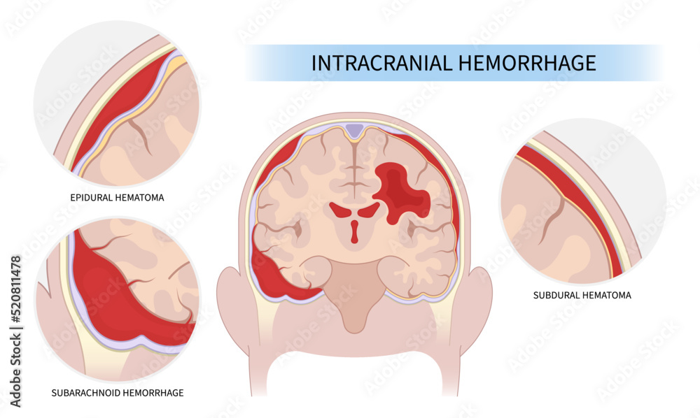 thrombosis basal ganglia cancer Brain traumatic injury and High blood