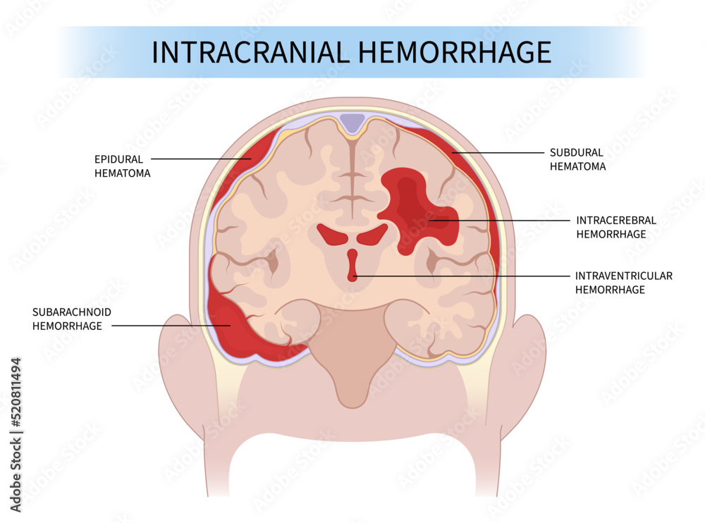 Brain traumatic injury and High blood pressure Loss of sickle cell