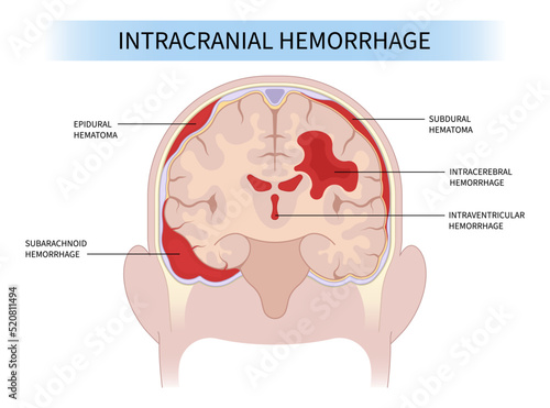 Brain traumatic injury and High blood pressure Loss of sickle cell anemia cancer tumor dura mater skull fracture hit fall exam bleed venous sinus thrombosis basal ganglia CT scan Tomography meninges photo
