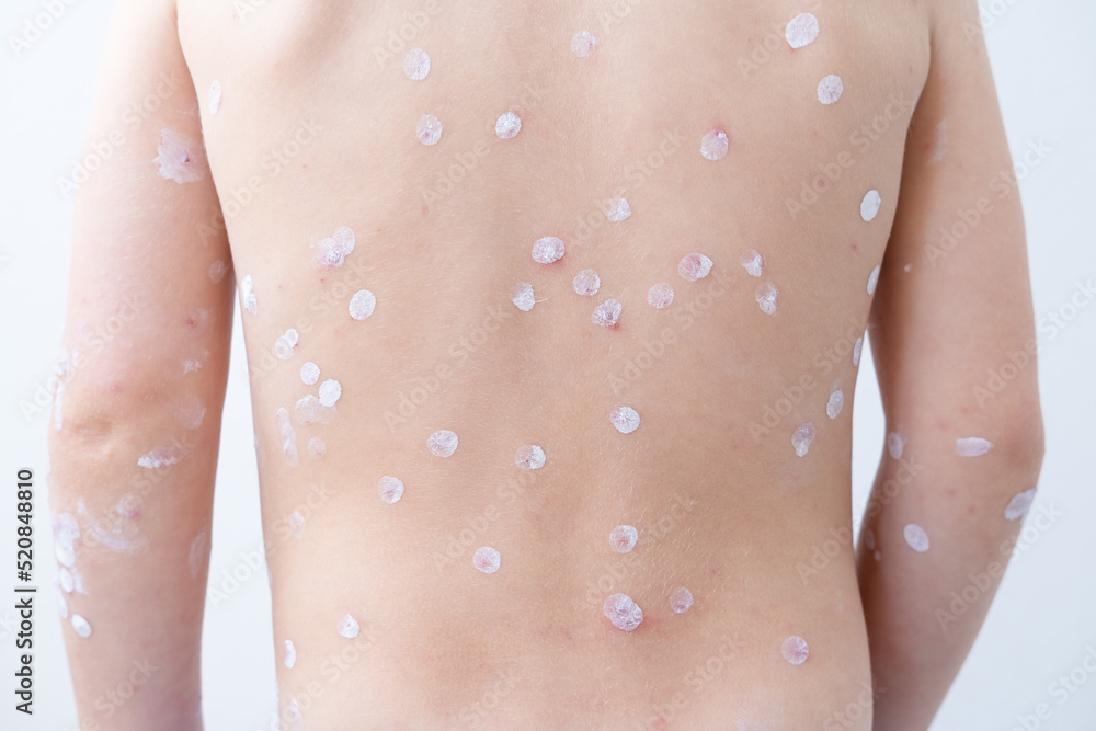 back of blonde little boy with red rashes Chicken pox virus, varicella with medical cream back of blonde little boy with red rashes Chicken pox virus, varicella with medical cream