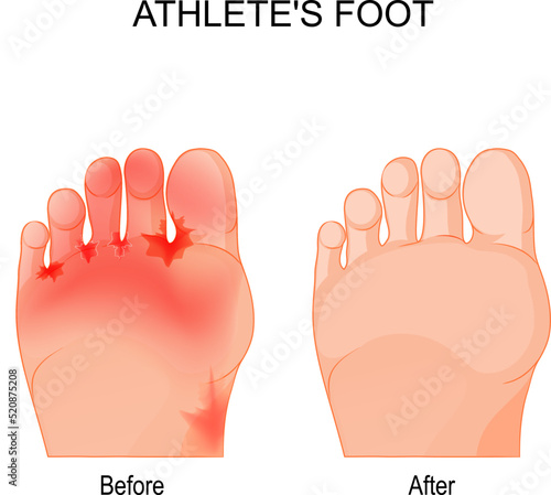 Athlete's foot before and after therapy.