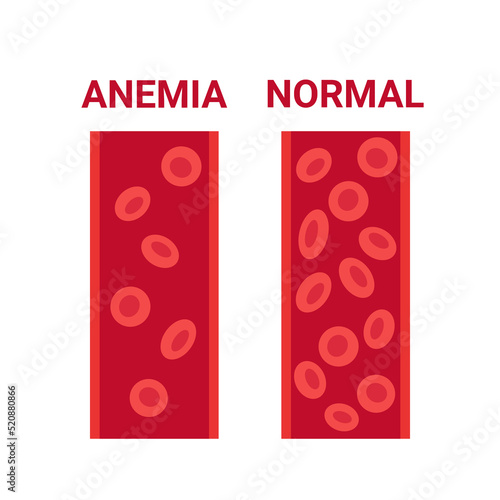 Normal and anemia blood in vessel comparison, number circulation cells erythrocyte. Hemoglobin low level, iron deficiency anemia. Disease anemic blood cells. Health problem. Vector illustration