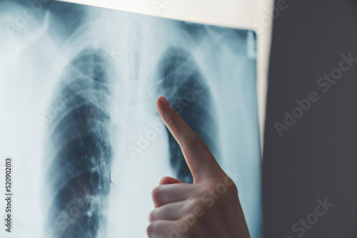 a finger pointing on a scan of lungs - closeup. High quality photo