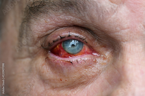 Eye of a man with injured conjunctiva due to an accident, sutured with several stitches and blood shot after surgery, health and medical theme, selected focus photo
