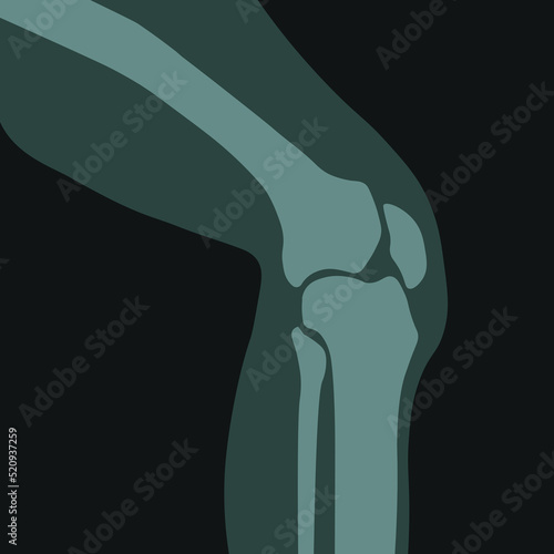 Xray of knee joint, roentgen scan of human body