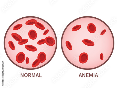 Hemoglobin. Anemia symptoms, blood disease. Health care concept.