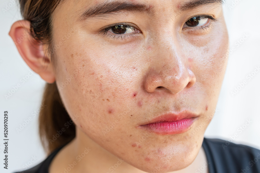 Head shot of Asian woman having problems of acne inflamed on her face. Head shot of Asian woman having problems of acne inflamed on her face.