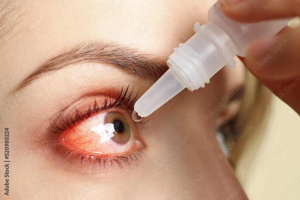 Closeup view of woman with inflamed eyes using drops Closeup view of woman with inflamed eyes using drops