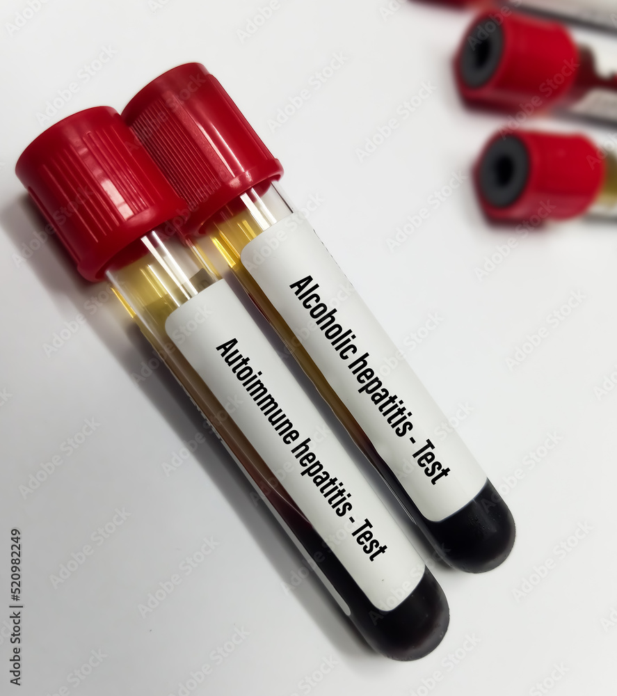 Blood sample for Alcoholic and autoimmune hepatitis test, rare liver disease. Stock Photo