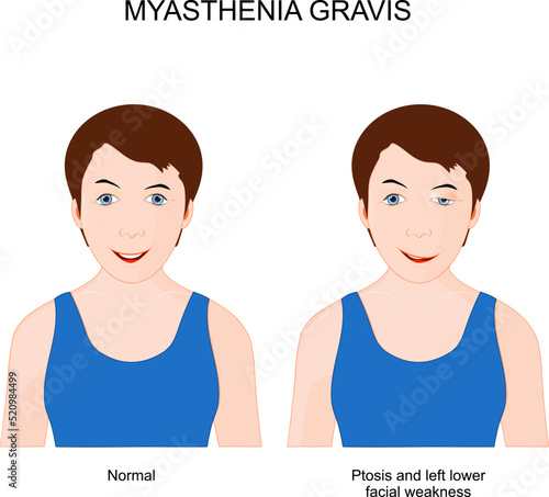 Myasthenia gravis. Girl with neuromuscular disease.