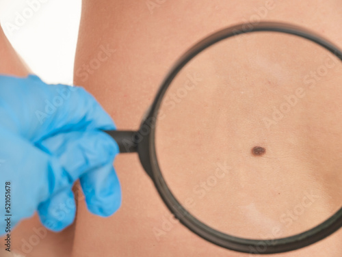 doctor examines the growths on the skin of an adult with a magnifying glass, diagnosis of skin cancer. Dermatologist examines the moles of the patient on a light background