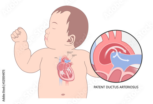 patent ductus arteriosus of pulmonary arteries photo