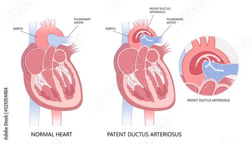 patent ductus arteriosus of pulmonary arteries photo