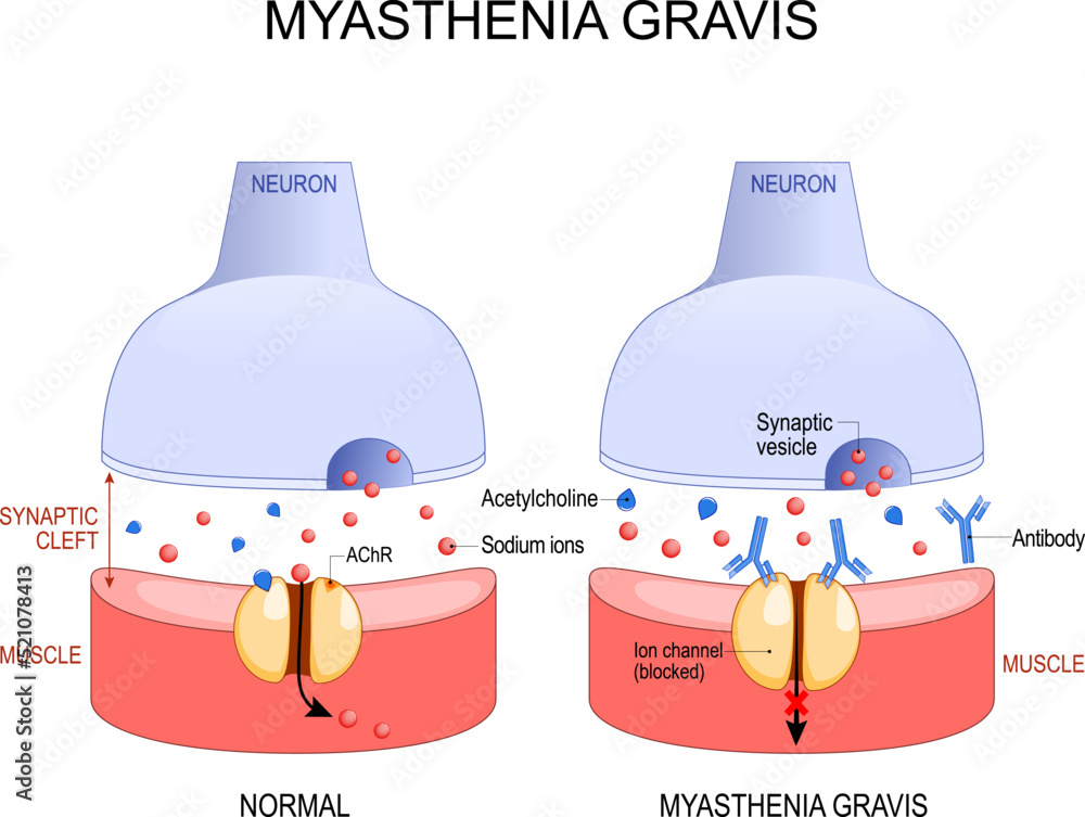 Photo &amp; Art Print Myasthenia gravis. Autoimmune disease. neuron and muscle., designua