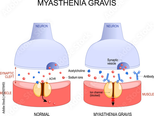 Myasthenia gravis. Autoimmune disease. neuron and muscle. photo